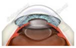 IOL Intraocular Lens Implant Treatment Mumbai India, Intraocular Lenses, IOL Intraocular Lens Implant Treatment Delhi Hospital